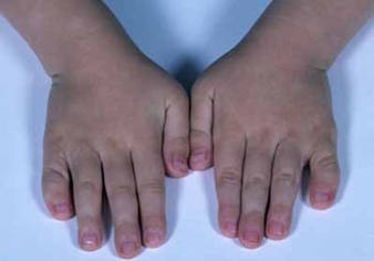 clinodactilia