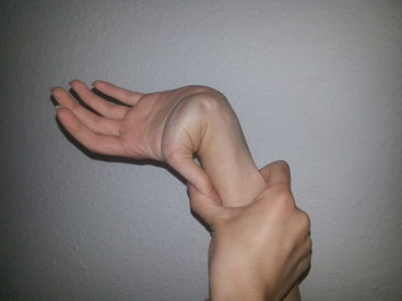 hipermobilidade